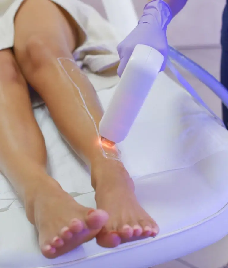 depilacja laserowa nogi